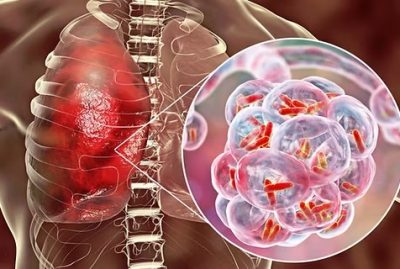 nxnoticias.com-rebasan-4-mil-casos-de-tuberculosis-en-mexico