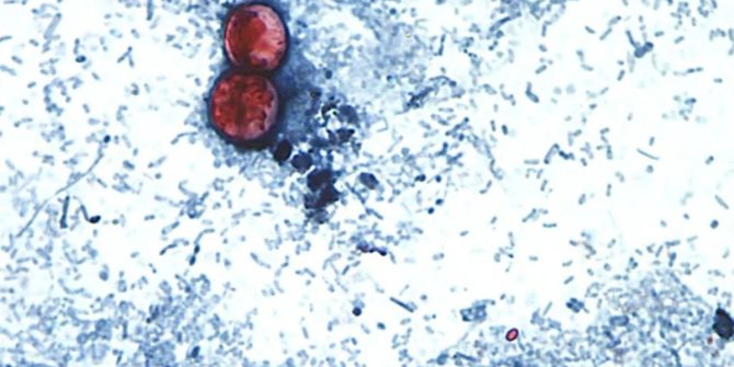 brote de ciclosporosis.