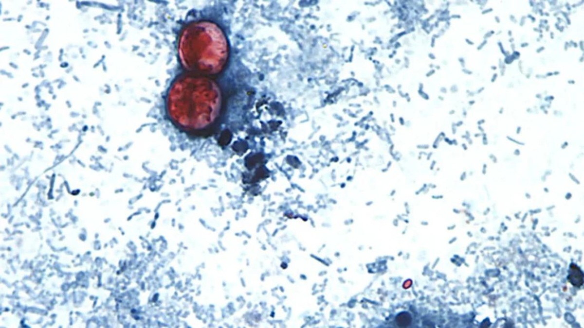 brote de ciclosporosis.
